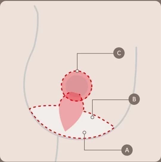 ภาพแสดงแนวแผลและทิศทางการยกในการยกกระชับหน้าอก