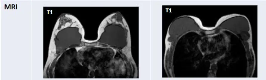 ถุงเต้านมเทียมแตก จำเป็นต้องทำ MRI เสมอไปหรือไม่? ตรวจด้วยอัลตราซาวด์ได้หรือเปล่า — ภาพประกอบบทความ 6