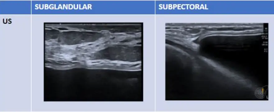 ถุงเต้านมเทียมแตก จำเป็นต้องทำ MRI เสมอไปหรือไม่? ตรวจด้วยอัลตราซาวด์ได้หรือเปล่า — ภาพประกอบบทความ 5