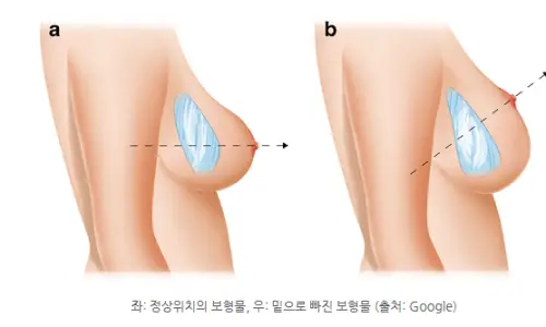 ผ่าตัดแก้ไขซิลิโคนไหลต่ำ (bottoming out)? สรุปวิธีตามแผลรักแร้/แผลใต้ราวนม <คำแนะนำจากประสบการณ์วิจัย 20 ปี> — 본문 이미지