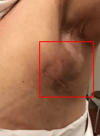 ระยะพักฟื้นหลังผ่าตัดหน้าอก กับภาวะแทรกซ้อน 2 อย่างที่อาจทำให้ล่าช้าเกิน 1 สัปดาห์ <คำแนะนำจากประสบการณ์วิจัย 20 ปี> — 본문 이미지