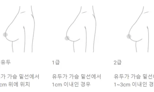รีวิวศัลยกรรมหน้าอกหย่อนคล้อย? อย่าหลงเชื่อ — ภาพประกอบบทความ 12