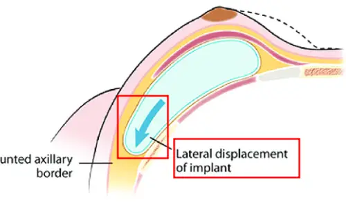 ผ่าตัดแก้ไขซิลิโคนไหลต่ำ (bottoming out)? สรุปวิธีตามแผลรักแร้/แผลใต้ราวนม <คำแนะนำจากประสบการณ์วิจัย 20 ปี> — 본문 이미지