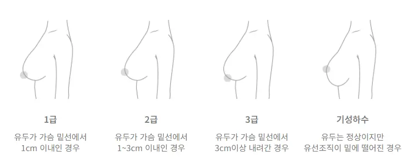 หน้าอกหย่อนคล้อยหลังคลอด — เข้าใจผิดว่าแค่เติมเต็มอกส่วนบนด้วยซิลิโคนก็พอ? — ภาพประกอบบทความ 6