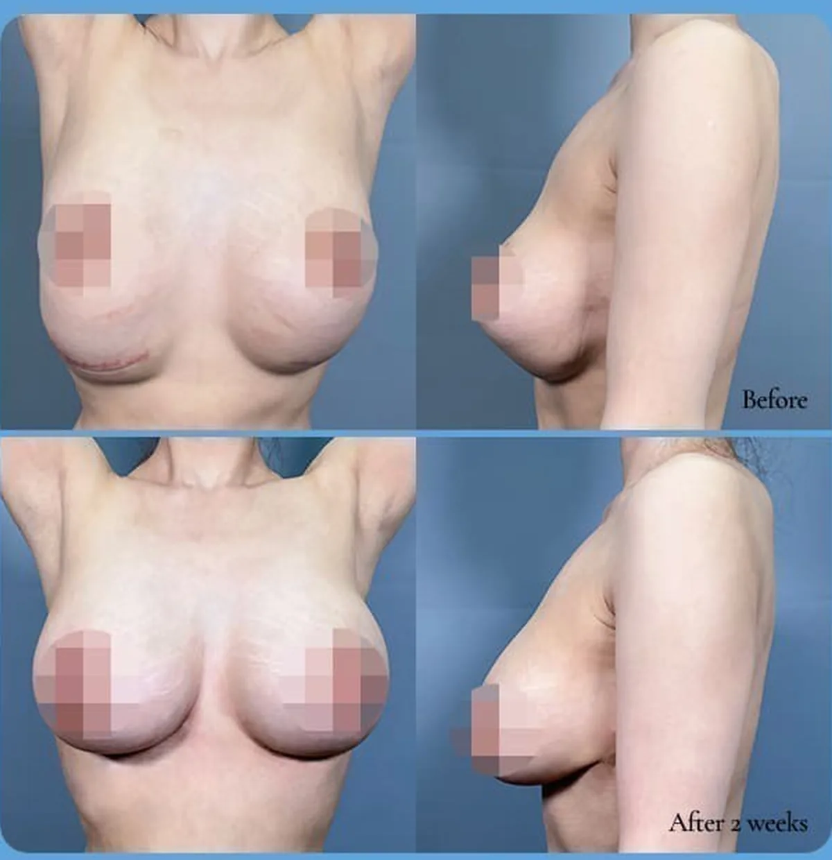 ภาพเปรียบเทียบก่อน-หลังแก้ซิลิโคนหย่อนต่ำ — Before / After 2 weeks (ด้านหน้า·ด้านข้าง)