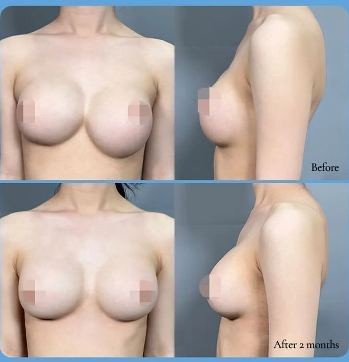 ภาพเปรียบเทียบก่อน-หลังแก้อกติดกัน·ซิลิโคนหย่อนต่ำ — Before / After 2 months (ด้านหน้า·ด้านข้าง)