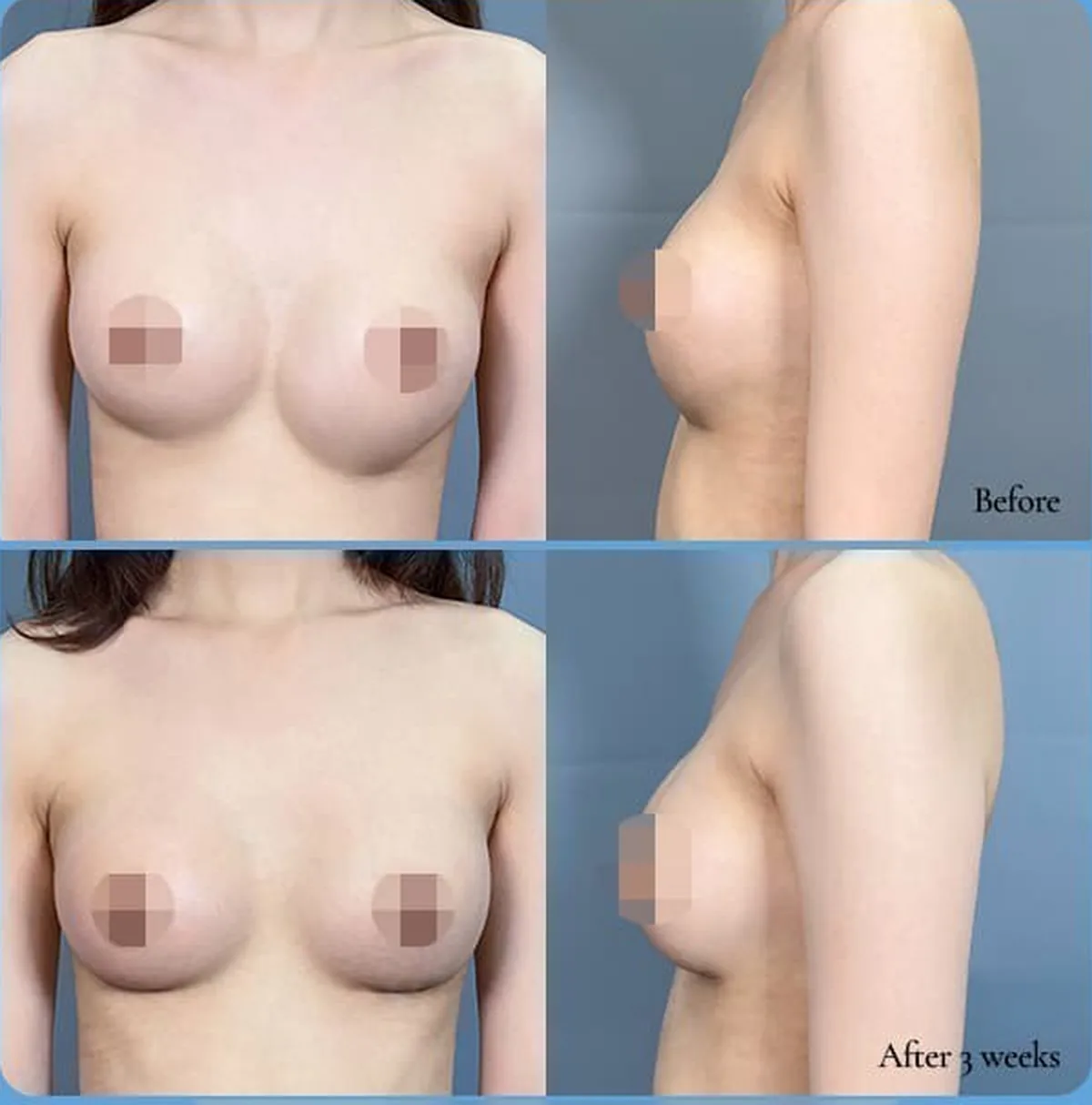 ภาพเปรียบเทียบก่อน-หลังแก้หน้าอกสองข้างไม่เท่ากันจากซิลิโคนหย่อนต่ำ — Before / After 3 weeks (ด้านหน้า·ด้านข้าง)