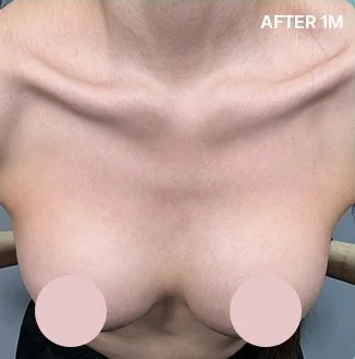 ภาพหน้าอกส่วนบน 1 เดือนหลังทำแก้ริ้วคลื่น