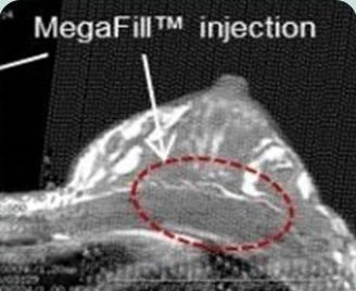 MegaFill™ injection — ภาพ CT ด้านข้างของหน้าอก ระบุตำแหน่งที่ปลูกถ่าย