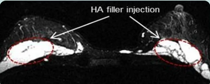 HA filler injection — ภาพ MRI แนวขวางของหน้าอกทั้งสองข้าง ระบุตำแหน่งฉีดฟิลเลอร์