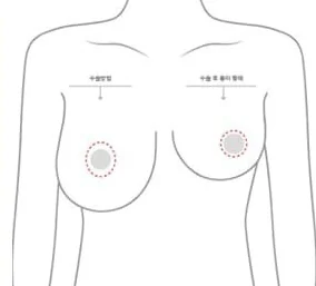 แผนภาพลำตัวส่วนบนแสดงตำแหน่งผ่ารอบปานนมและรูปแบบแผลเป็นหลังผ่าตัด