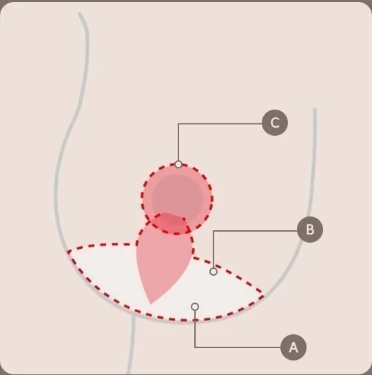 แผนภาพออกแบบแนวผ่ายกกระชับอก — A แนวใต้ราวนม, B เส้นด้านข้าง, C รอบปานนม
