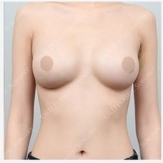 ภาพหลังผ่าตัดแก้ไขหน้าอกข้างเดียว 5