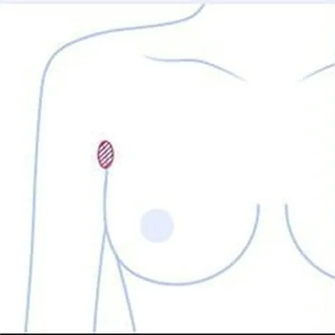 ภาพประกอบครึ่งตัวบนแสดงตำแหน่งแผลผ่าใต้รักแร้