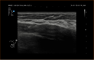 Healthy Breast อัลตราซาวนด์ซิลิโคน img10 m
