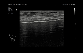 Healthy Breast อัลตราซาวนด์ซิลิโคน img11 m
