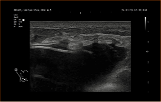Healthy Breast อัลตราซาวนด์ซิลิโคน img8 m