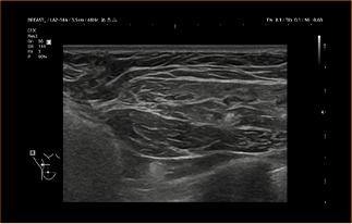Healthy Breast อัลตราซาวนด์ซิลิโคน img9 m