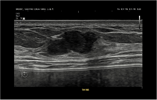 Healthy Breast อัลตราซาวนด์มะเร็งเต้านม img10 m