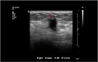 Healthy Breast อัลตราซาวนด์มะเร็งเต้านม img11 m