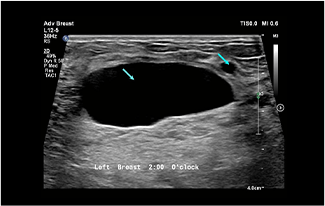 Healthy Breast อัลตราซาวนด์มะเร็งเต้านม img12 m