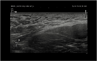 Healthy Breast อัลตราซาวนด์มะเร็งเต้านม img13 m