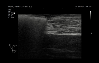 Healthy Breast อัลตราซาวนด์มะเร็งเต้านม img14 m