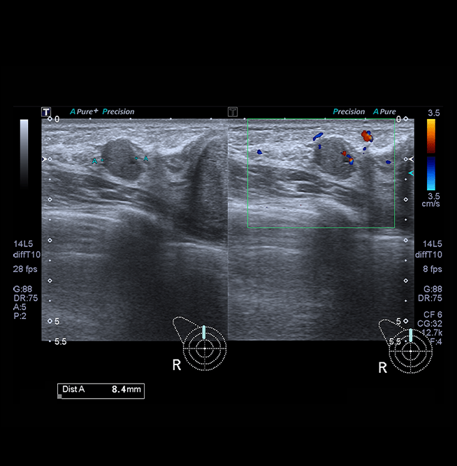 Healthy Breast อัลตราซาวนด์มะเร็งเต้านม img17 m