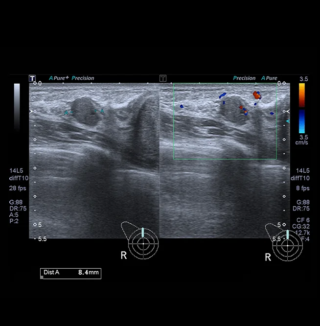 Healthy Breast อัลตราซาวนด์มะเร็งเต้านม img17 m