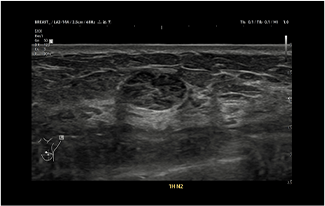 Healthy Breast อัลตราซาวนด์มะเร็งเต้านม img9 m