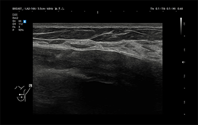 healthy breast อัลตราซาวนด์ซิลิโคน img10