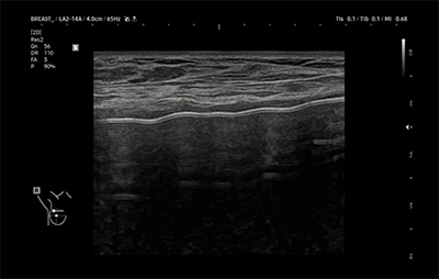 healthy breast อัลตราซาวนด์ซิลิโคน img11