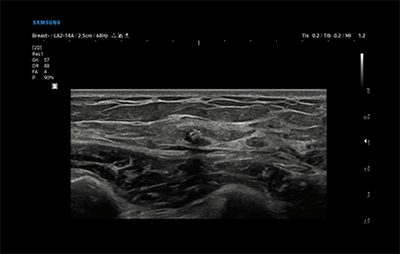 healthy breast อัลตราซาวนด์ซิลิโคน img5