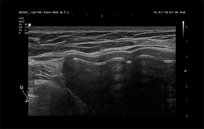 healthy breast อัลตราซาวนด์ซิลิโคน img6