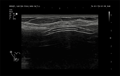 healthy breast อัลตราซาวนด์ซิลิโคน img7
