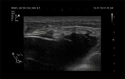 healthy breast อัลตราซาวนด์ซิลิโคน img8