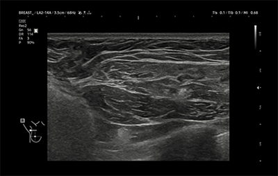 healthy breast อัลตราซาวนด์ซิลิโคน img9