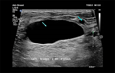 healthy breast อัลตราซาวนด์มะเร็งเต้านม img10