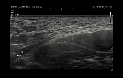 healthy breast อัลตราซาวนด์มะเร็งเต้านม img11