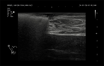 healthy breast อัลตราซาวนด์มะเร็งเต้านม img12