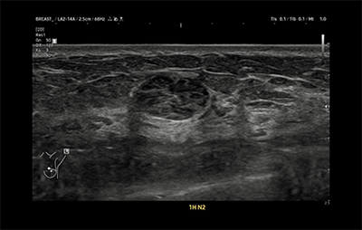 healthy breast อัลตราซาวนด์มะเร็งเต้านม img7