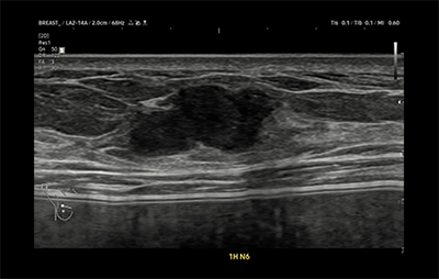 healthy breast อัลตราซาวนด์มะเร็งเต้านม img8