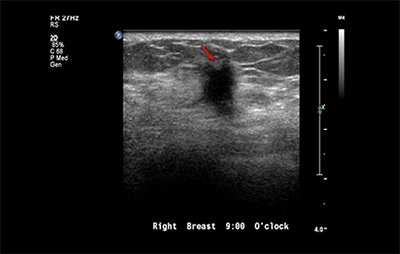 healthy breast อัลตราซาวนด์มะเร็งเต้านม img9